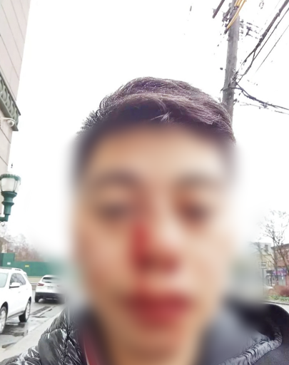 求助！福州华男送外卖 遭非裔男暴打！鼻梁骨折、颅内出血 家中3幼孩惨断生计...